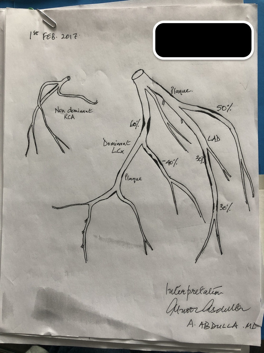 Dr. Abdulla's hand-drawn 2017 interpretation of a coronary angiogram, showing the dominant LCx, LAD, and non-dominant RCA with plaque percentages marked, signed A. Abdulla MD
